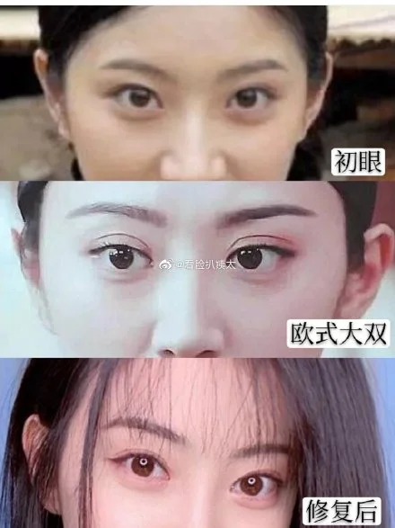 Botched asian eyelid clearance surgery